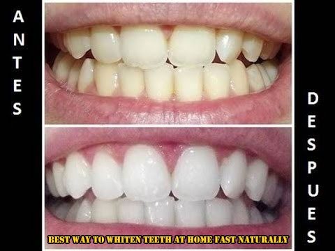 Best Way To Whiten Teeth At Home Fast