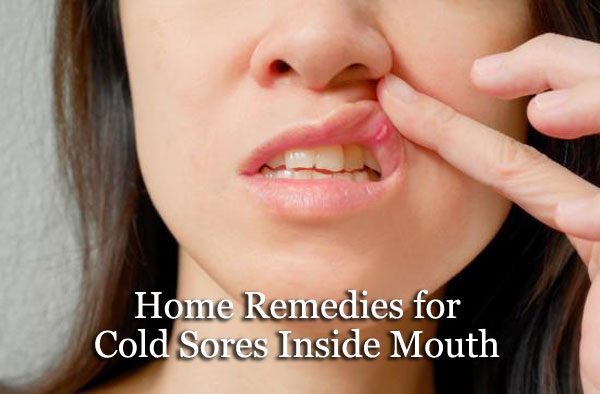 Home Remedies for Cold Sores Inside Mouth