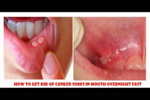 how to get rid of canker sores in mouth overnight