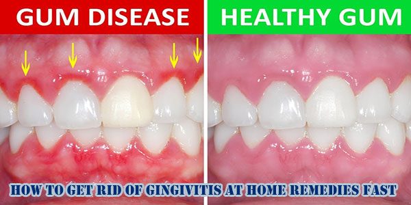 How To Get Rid Of Gingivitis At Home Remedies Fast