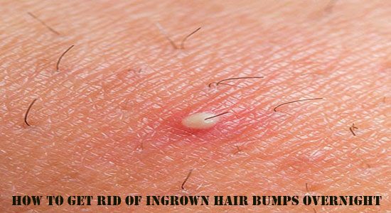How To Get Rid Of Ingrown Hair Bumps Overnight