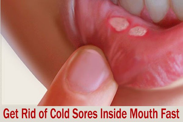 How to Get Rid of Cold Sores Inside Mouth Fast