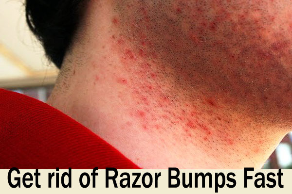 How to Get rid of Razor Bumps Fast