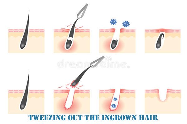 pulling out ingrown pubic hair