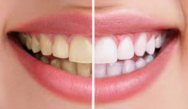 Wax Tooth Cap With Coconut Oil uses to get rid of Canker Sores In Mouth fast