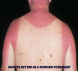 how to get rid of a sunburn overnight